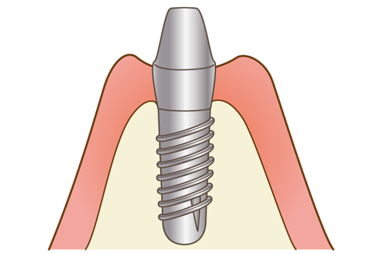 インプラント手術