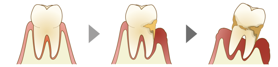 歯周病とは